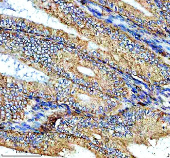 Immunohistochemical staining of NTN4 using anti-NTN4 antibody. NTN4 was detected in a paraffin-embedded section of human endometrial cancer tissue. Heat mediated antigen retrieval was performed in EDTA buffer (pH 8.0, epitope retrieval solution). The tissue section was blocked with 10% goat serum. The tissue section was then incubated with 2 ug/ml rabbit anti-NTN4 antibody overnight at 4oC. Peroxidase Conjugated Goat Anti-rabbit IgG was used as secondary antibody and incubated for 30 min at 37oC.