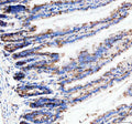 Immunohistochemical staining of Neurokinin 1 Receptor using anti-NKR1 antibody. Neurokinin 1 Receptor was detected in a paraffin-embedded section of human lung cancer tissue. Heat mediated antigen retrieval was performed in EDTA buffer (pH 8.0, epitope retrieval solution). The tissue section was blocked with 10% goat serum. The tissue section was then incubated with 1:50 rabbit anti-NKR1 antibody overnight at 4oC.
