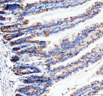 Immunohistochemical staining of Neurokinin 1 Receptor using anti-NKR1 antibody. Neurokinin 1 Receptor was detected in a paraffin-embedded section of human lung cancer tissue. Heat mediated antigen retrieval was performed in EDTA buffer (pH 8.0, epitope retrieval solution). The tissue section was blocked with 10% goat serum. The tissue section was then incubated with 1:50 rabbit anti-NKR1 antibody overnight at 4oC.