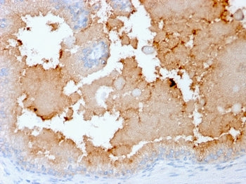 IHC staining of FFPE human prostate carcinoma with recombinant AKT1 antibody (clone rAKT1/2491). HIER: boil tissue sections in pH 9 10mM Tris with 1mM EDTA for 10-20 min followed by cooling at RT for 20 min.