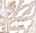 Immunohistochemical staining of GBF1 using anti-GBF1 antibody. GBF1 was detected in a paraffin-embedded section of human prostate cancer tissue. Heat mediated antigen retrieval was performed in EDTA buffer (pH 8.0, epitope retrieval solution). The tissue section was blocked with 10% goat serum. The tissue section was then incubated with 2 ug/ml rabbit anti-GBF1 antibody overnight at 4oC. Peroxidase Conjugated Goat Anti-rabbit IgG was used as secondary antibody and incubated for 30 min at 37oC.