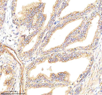 Immunohistochemical staining of GBF1 using anti-GBF1 antibody. GBF1 was detected in a paraffin-embedded section of human prostate cancer tissue. Heat mediated antigen retrieval was performed in EDTA buffer (pH 8.0, epitope retrieval solution). The tissue section was blocked with 10% goat serum. The tissue section was then incubated with 2 ug/ml rabbit anti-GBF1 antibody overnight at 4oC. Peroxidase Conjugated Goat Anti-rabbit IgG was used as secondary antibody and incubated for 30 min at 37oC.