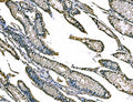 IHC staining of FFPE human gastric cancer tissue with Claudin 18 antibody. HIER: boil tissue sections in pH8 EDTA for 20 min and allow to cool before testing.