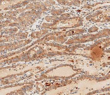 IHC staining of FFPE human thyroid carcinoma with WNT5A antibody. HIER: boil tissue sections in pH 9 EDTA for 20 min and allow to cool before testing.