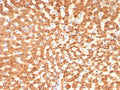 IHC staining of FFPE human hepatocellular carcinoma tissue with SHBG antibody (clone SHBG/8175). HIER: boil tissue sections in pH 9 10mM Tris with 1mM EDTA for 20 min and allow to cool before testing.