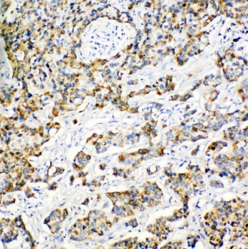 IHC staining of FFPE human breast cancer tissue with Peroxiredoxin 3 antibody. HIER: boil tissue sections in pH8 EDTA for 20 min and allow to cool before testing.