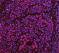 Immunofluorescent staining of FFPE human pancreas cancer tissue with DEAD box protein 1 antibody. HIER: boil tissue sections in pH8 EDTA for 20 min and allow to cool before testing.