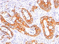 IHC: Formalin-fixed, paraffin-embedded human colon carcinoma stained with MUC-1 / EMA antibody cocktail (clones GP1.4 + E29).