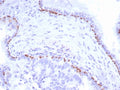 IHC staining of FFPE human prostate carcinoma tissue with p40 antibody (clone P40/8225R). HIER: boil tissue sections in pH 9 10mM Tris with 1mM EDTA for 20 min and allow to cool before testing.