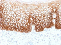IHC testing of FFPE human cervical carcinoma with CD44v9 antibody (clone CD44v9/1459). Required HIER: steam sections in pH 9 10mM Tris with 1mM EDTA buffer for 10-20 min.