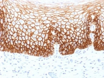 IHC testing of FFPE human cervical carcinoma with CD44v9 antibody (clone CD44v9/1459). Required HIER: steam sections in pH 9 10mM Tris with 1mM EDTA buffer for 10-20 min.