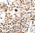 Immunohistochemical staining of TMPO using anti-TMPO antibody. TMPO was detected in a paraffin-embedded section of human lung cancer tissue. Heat mediated antigen retrieval was performed in EDTA buffer (pH 8.0, epitope retrieval solution). The tissue section was blocked with 10% goat serum. The tissue section was then incubated with 2 ug/ml rabbit anti-TMPO antibody overnight at 4oC. Peroxidase Conjugated Goat Anti-rabbit IgG was used as secondary antibody and incubated for 30 min at 37oC.