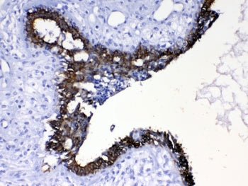 IHC testing of FFPE human breast cancer tissue with Cytokeratin 8 antibody at 1ug/ml. Required HIER: steam section in pH6 citrate buffer for 20 min and allow to cool prior to testing.