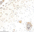 Immunohistochemical staining of Biglycan/BGN using anti-BGN antibody. Biglycan/BGN was detected in a paraffin-embedded section of human breast cancer tissue. Heat mediated antigen retrieval was performed in EDTA buffer (pH 8.0, epitope retrieval solution). The tissue section was blocked with 10% goat serum. The tissue section was then incubated with 2 ug/ml rabbit anti-BGN antibody overnight at 4oC. Peroxidase Conjugated Goat Anti-rabbit IgG was used as secondary antibody and incubated for 30 min at 37oC.