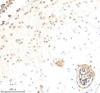 Immunohistochemical staining of Biglycan/BGN using anti-BGN antibody. Biglycan/BGN was detected in a paraffin-embedded section of human breast cancer tissue. Heat mediated antigen retrieval was performed in EDTA buffer (pH 8.0, epitope retrieval solution). The tissue section was blocked with 10% goat serum. The tissue section was then incubated with 2 ug/ml rabbit anti-BGN antibody overnight at 4oC. Peroxidase Conjugated Goat Anti-rabbit IgG was used as secondary antibody and incubated for 30 min at 37oC.