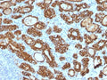 IHC testing of FFPE human thyroid carcinoma stained with Thyroid Peroxidase antibody (clone TPO/1922). Required HIER: boil tissue sections in 10mM citrate buffer, pH 6, for 10-20 min followed by cooling at RT for 20 min.