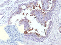 IHC staining of FFPE human prostate cancer tissue with ABCC4 antibody (clone ABCC4/9018). Inset: PBS used in place of primary Ab (secondary Ab negative control).