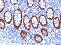 IHC staining of FFPE human colon carcinoma tissue with PU.1 antibody (clone PU1/2118). HIER: boil tissue sections in pH 9 10mM Tris with 1mM EDTA for 20 min and allow to cool before testing.