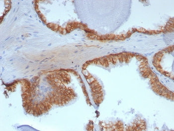IHC staining of FFPE human prostate tissue with CTNNB1 antibody (clone rCTNNB1/8043). HIER: boil tissue sections in pH 9 10mM Tris with 1mM EDTA for 20 min and allow to cool before testing.
