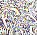 IHC staining of STOML2 using anti-STOML2 antibody. STOML2 was detected in a paraffin-embedded section of human colon cancer tissue. Heat mediated antigen retrieval was performed in EDTA buffer (pH 8.0, epitope retrieval solution). The tissue section was blocked with 10% goat serum. The tissue section was then incubated with 2 ug/ml rabbit anti-STOML2 antibody overnight at 4oC. Peroxidase Conjugated Goat Anti-rabbit IgG was used as secondary antibody and incubated for 30 min at 37oC.