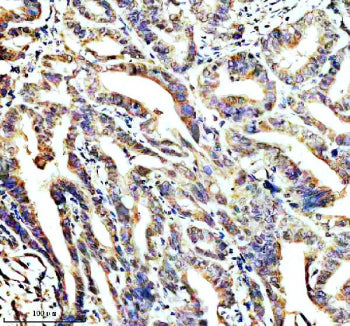 IHC staining of STOML2 using anti-STOML2 antibody. STOML2 was detected in a paraffin-embedded section of human colon cancer tissue. Heat mediated antigen retrieval was performed in EDTA buffer (pH 8.0, epitope retrieval solution). The tissue section was blocked with 10% goat serum. The tissue section was then incubated with 2 ug/ml rabbit anti-STOML2 antibody overnight at 4oC. Peroxidase Conjugated Goat Anti-rabbit IgG was used as secondary antibody and incubated for 30 min at 37oC.