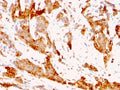 IHC analysis of formalin-fixed, paraffin-embedded human breast carcinoma tissue stained with GRP94 antibody (clone 9G10.F8.2). HIER: boil tissue sections in pH 9 10mM Tris with 1mM EDTA for 20 min and allow to cool before testing.