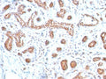 IHC testing of FFPE human breast carcinoma with GATA3 antibody. Required HIER: boil tissue sections in 10mM citrate buffer, pH 6, for 10-20 min and allow to cool prior to testing.