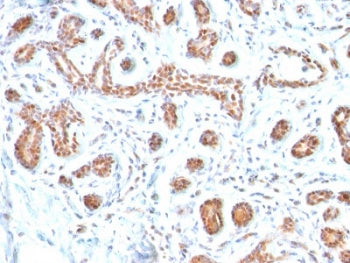 IHC testing of FFPE human breast carcinoma with GATA3 antibody. Required HIER: boil tissue sections in 10mM citrate buffer, pH 6, for 10-20 min and allow to cool prior to testing.