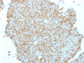 IHC testing of FFPE human Ewing's sarcoma with CD99 antibody. Required HIER: steam sections in 10mM citrate buffer, pH 6.0, for 10-20 min.