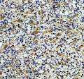 IHC staining of FFPE human glioma tissue with CAMK2 antibody, HRP-secondary and DAB substrate. HIER: boil tissue sections in pH8 EDTA for 20 min and allow to cool before testing.