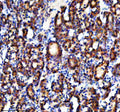 Immunohistochemical staining of NAGK using anti-NAGK antibody. NAGK was detected in a paraffin-embedded section of human thyroid cancer tissue. Heat mediated antigen retrieval was performed in EDTA buffer (pH 8.0, epitope retrieval solution). The tissue section was blocked with 10% goat serum. The tissue section was then incubated with 2 ug/ml rabbit anti-NAGK antibody overnight at 4oC. Peroxidase Conjugated Goat Anti-rabbit IgG was used as secondary antibody and incubated for 30 min at 37oC.