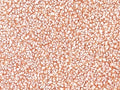IHC: Formalin-fixed, paraffin-embedded human Ewing's sarcoma stained with CD99 antibody (SPM586).