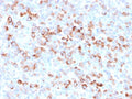 IHC staining of FFPE human Melanoma with recombinant Tyrosinase antibody (clone rOCA1/812). Required HIER: boil tissue sections in 10mM Tris with 1mM EDTA, pH9, or 10mM citrate buffer, pH6, for 10-20 min followed by cooling at RT for 20 min.