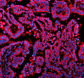 Immunofluorescent staining of NSDHL using anti-NSDHL antibody (red). NSDHL was detected in a paraffin-embedded section of human liver cancer tissue. Heat mediated antigen retrieval was performed in EDTA buffer (pH 8.0, epitope retrieval solution). The tissue section was blocked with 10% goat serum. The tissue section was then incubated with 5 ug/ml rabbit anti-NSDHL antibody overnight at 4oC.