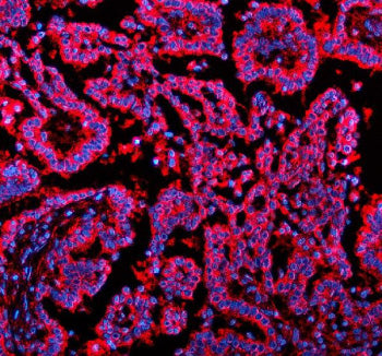 Immunofluorescent staining of NSDHL using anti-NSDHL antibody (red). NSDHL was detected in a paraffin-embedded section of human liver cancer tissue. Heat mediated antigen retrieval was performed in EDTA buffer (pH 8.0, epitope retrieval solution). The tissue section was blocked with 10% goat serum. The tissue section was then incubated with 5 ug/ml rabbit anti-NSDHL antibody overnight at 4oC.