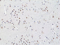 IHC staining of FFPE human brain cancer tissue with recombinant HDCAC3 antibody at 1:200.