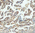 IHC staining of FFPE human lung cancer tissue with Bax antibody, HRP-labeled secondary and DAB substrate. HIER: boil tissue sections in pH8 EDTA for 20 min and allow to cool before testing.