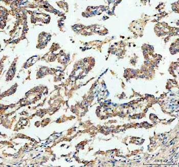 IHC staining of FFPE human lung cancer tissue with Bax antibody, HRP-labeled secondary and DAB substrate. HIER: boil tissue sections in pH8 EDTA for 20 min and allow to cool before testing.
