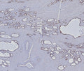 IHC staining of FFPE human prostate carcinoma tissue with Cytokeratin 5/6 antibody (clone KRT5.6/8275R). HIER: boil tissue sections in pH 9 10mM Tris with 1mM EDTA for 20 min and allow to cool before testing.