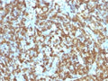 IHC testing of anti-CD45RO antibody and FFPE human lymphoma