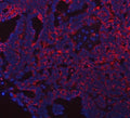 Immunofluorescent staining of FFPE human ovarian cancer tissue with PRDM15 antibody (red) and DAPI nuclear stain (blue). HIER: steam section in pH8 EDTA buffer for 20 min.