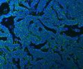 Immunofluorescent staining of FFPE human ovarian cancer tissue with SSBP1 antibody (green) and DAPI nuclear stain (blue). HIER: steam section in pH8 EDTA buffer for 20 min.