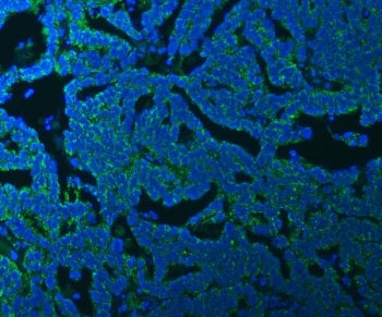 Immunofluorescent staining of FFPE human ovarian cancer tissue with SSBP1 antibody (green) and DAPI nuclear stain (blue). HIER: steam section in pH8 EDTA buffer for 20 min.