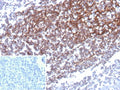 IHC staining of FFPE human prostate carcinoma with CD35 antibody (clone CD35/9444). Inset: PBS used in place of primary Ab (secondary Ab negative control). HIER: boil tissue sections in pH 9 10mM Tris with 1mM EDTA for 20 min and allow to cool before testing.