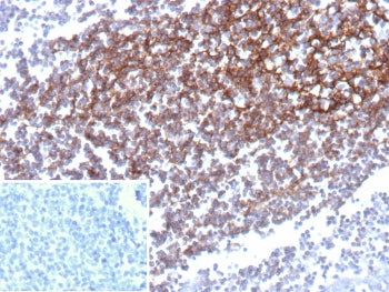 IHC staining of FFPE human prostate carcinoma with CD35 antibody (clone CD35/9444). Inset: PBS used in place of primary Ab (secondary Ab negative control). HIER: boil tissue sections in pH 9 10mM Tris with 1mM EDTA for 20 min and allow to cool before testing.