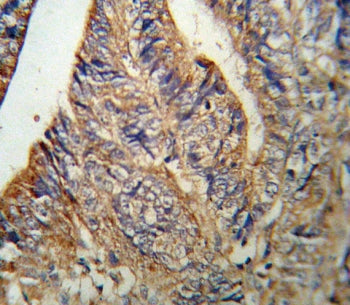 IHC testing of FFPE human colon carcinoma tissue with IL1RN antibody. HIER: steam section in pH6 citrate buffer for 20 min and allow to cool prior to staining.