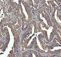 Immunohistochemical staining of STRIP1 using anti-STRIP1 antibody. STRIP1 was detected in a paraffin-embedded section of human colon cancer tissue. Heat mediated antigen retrieval was performed in EDTA buffer (pH 8.0, epitope retrieval solution). The tissue section was blocked with 10% goat serum. The tissue section was then incubated with 2 ug/ml rabbit anti-STRIP1 antibody overnight at 4oC. Peroxidase Conjugated Goat Anti-rabbit IgG was used as secondary antibody and incubated for 30 min at 37oC.