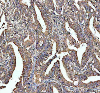 Immunohistochemical staining of STRIP1 using anti-STRIP1 antibody. STRIP1 was detected in a paraffin-embedded section of human colon cancer tissue. Heat mediated antigen retrieval was performed in EDTA buffer (pH 8.0, epitope retrieval solution). The tissue section was blocked with 10% goat serum. The tissue section was then incubated with 2 ug/ml rabbit anti-STRIP1 antibody overnight at 4oC. Peroxidase Conjugated Goat Anti-rabbit IgG was used as secondary antibody and incubated for 30 min at 37oC.