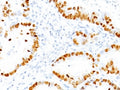 IHC: Formalin-fixed, paraffin-embedded human lung Adenocarcinoma stained with TTF-1 antibody (NX2.1/690)