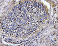 IHC staining of FFPE human lung cancer tissue with BIN1 antibody. HIER: boil tissue sections in pH8 EDTA for 20 min and allow to cool before testing.